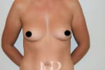 HR Plastic Surgery - Breast Enlargement patient before 1