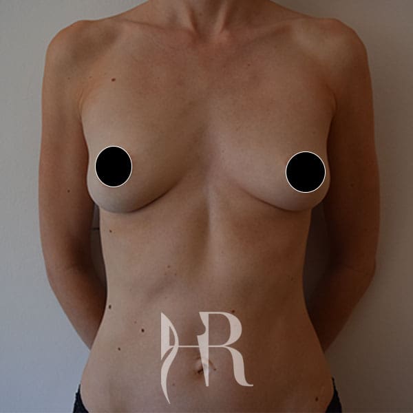 HR Plastic Surgery - Breast Enlargement patient before 12