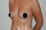 HR Plastic Surgery - Breast Enlargement patient before 2