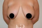HR Plastic Surgery - Breast Reduction patient before 1