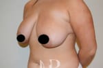 HR Plastic Surgery - Breast Reduction patient before 2