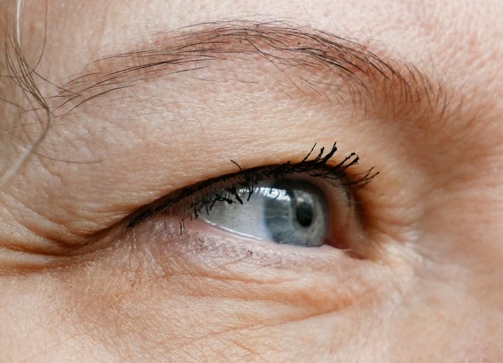 HR Plastic Sugery - Droopy eyelids - Eyelid bags - Loose excess eyelid skin