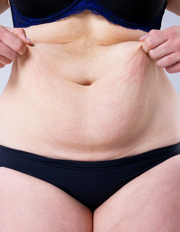 HR Plastic Sugery - Excess - loose abdominal skin Common Causes