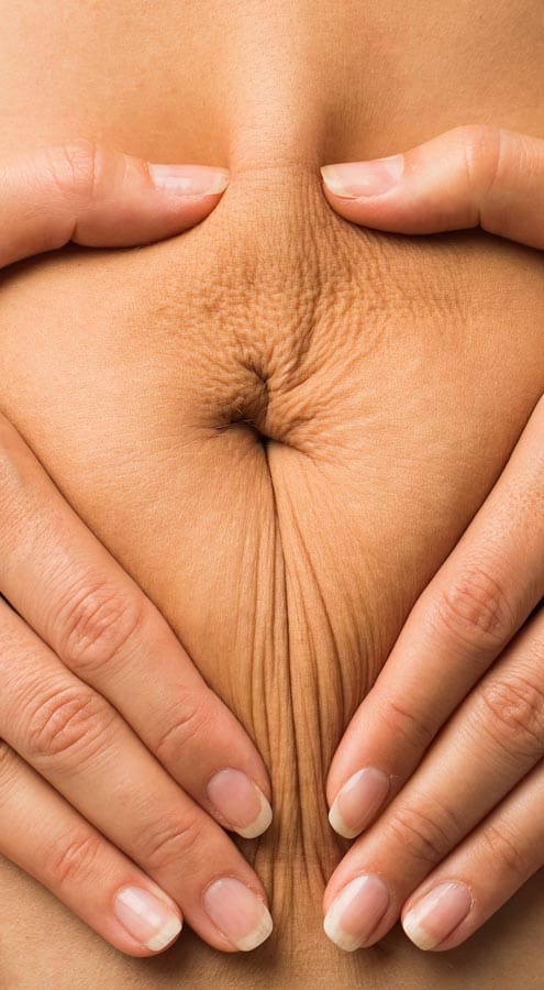 HR Plastic Sugery - Excess - loose abdominal skin
