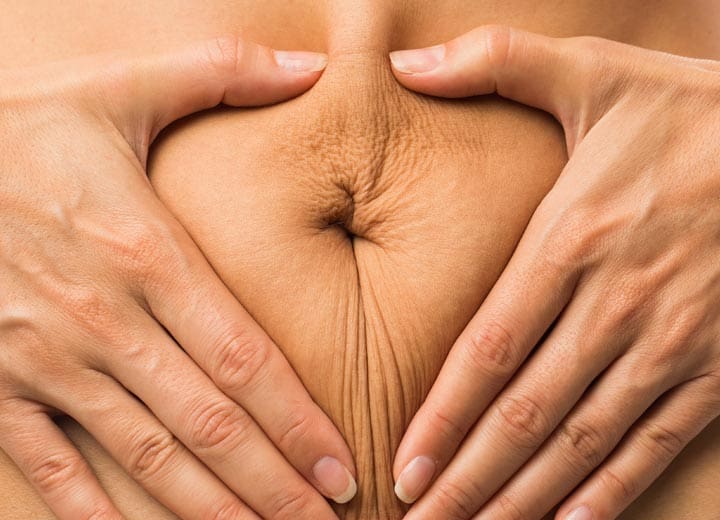 HR Plastic Sugery - Excess - loose abdominal skin