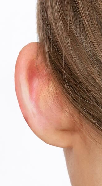 HR Plastic Sugery - Large ears - sticky out ears - Bat ears