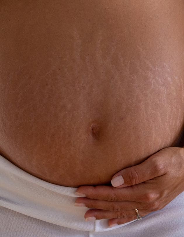 HR Plastic Sugery - Tummy stretch marks Common Causes