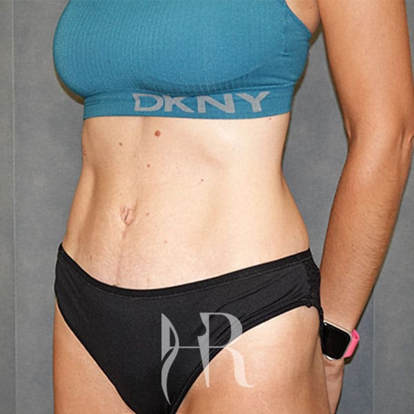 HR Plastic Surgery - Tummy Tuck patient after 12