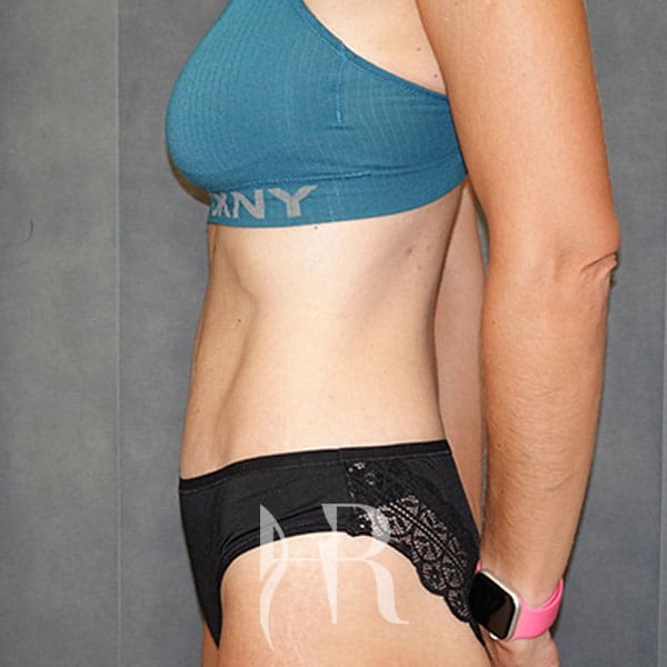 HR Plastic Surgery - Tummy Tuck patient after 13