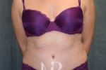 HR Plastic Surgery - Tummy Tuck patient after 14