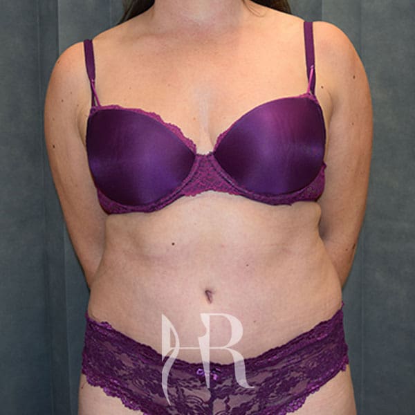 HR Plastic Surgery - Tummy Tuck patient after 14
