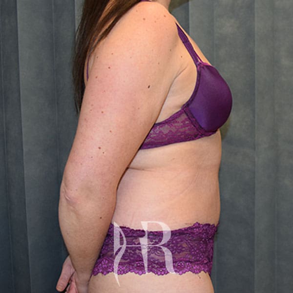 HR Plastic Surgery - Tummy Tuck patient after 15