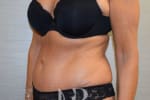 HR Plastic Surgery - Tummy Tuck patient after 17