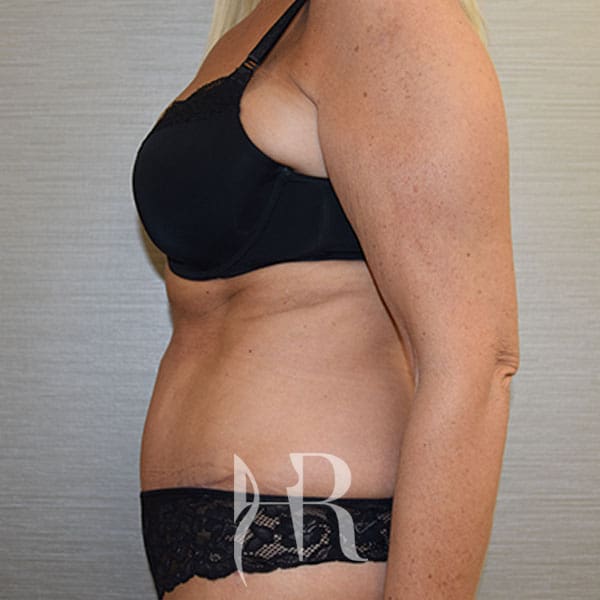 HR Plastic Surgery - Tummy Tuck patient after 18