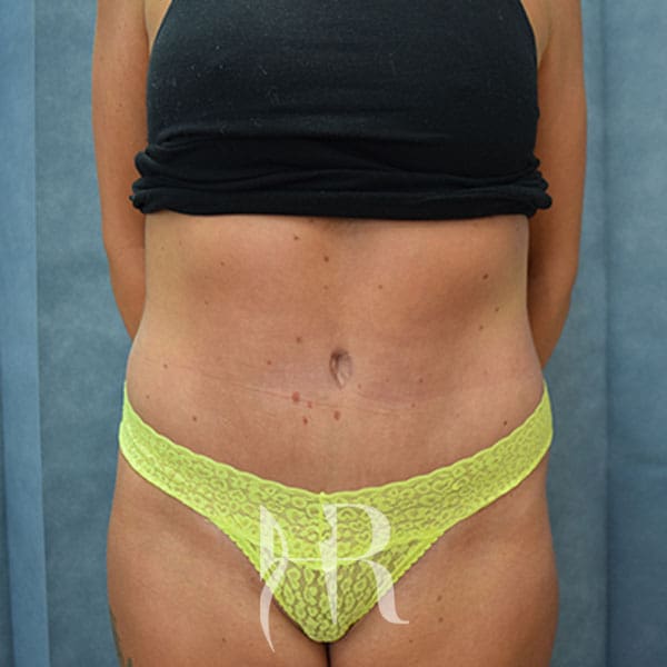 HR Plastic Surgery - Tummy Tuck patient after 19