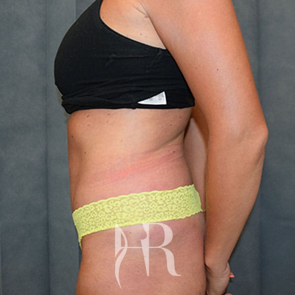 HR Plastic Surgery - Tummy Tuck patient after 21