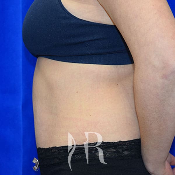 HR Plastic Surgery - Tummy Tuck patient after 25