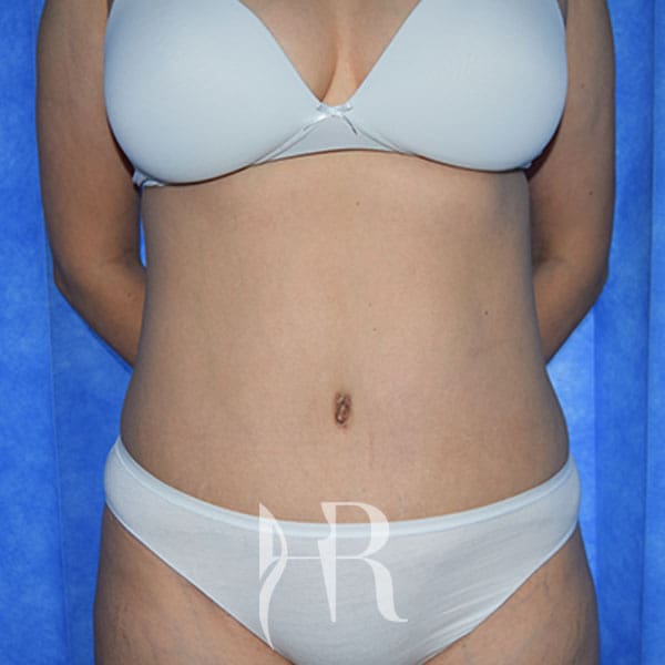 HR Plastic Surgery - Tummy Tuck patient after 26