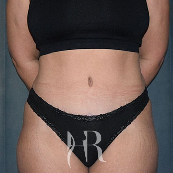 HR Plastic Surgery - Tummy Tuck patient after 6