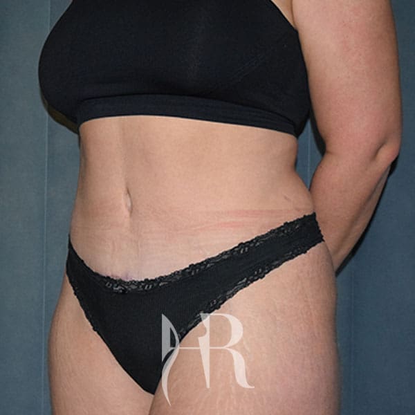 HR Plastic Surgery - Tummy Tuck patient after 7