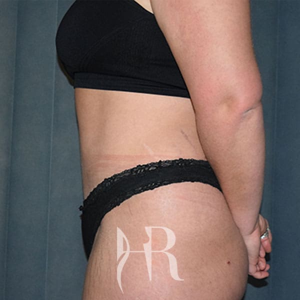 HR Plastic Surgery - Tummy Tuck patient after 8