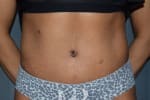 HR Plastic Surgery - Tummy Tuck patient after 9