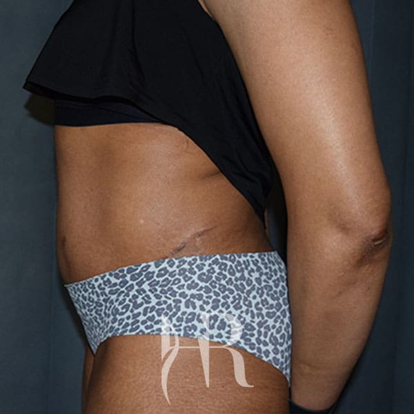 HR Plastic Surgery - Tummy Tuck patient after 10
