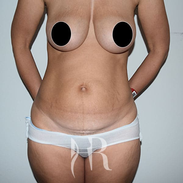 HR Plastic Surgery - Tummy Tuck patient before 3