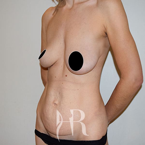 HR Plastic Surgery - Tummy Tuck patient before 12