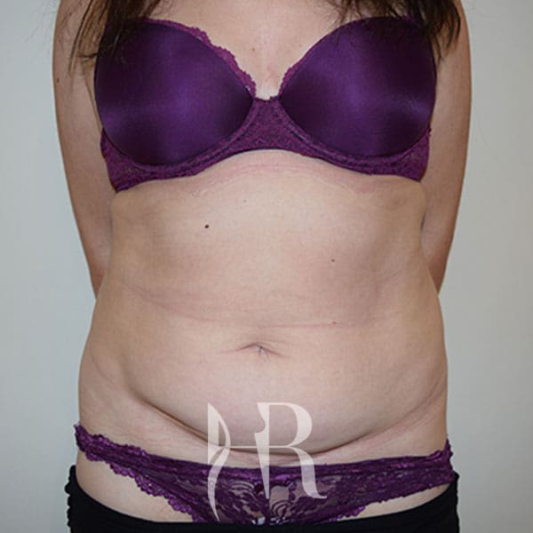 HR Plastic Surgery - Tummy Tuck patient before 14