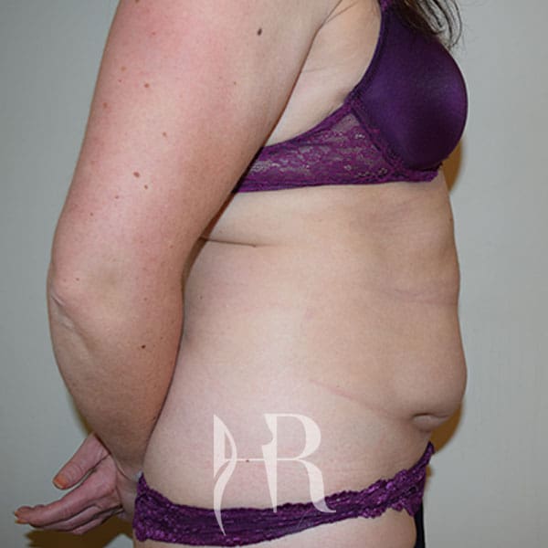 HR Plastic Surgery - Tummy Tuck patient before 15