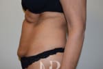 HR Plastic Surgery - Tummy Tuck patient before 18