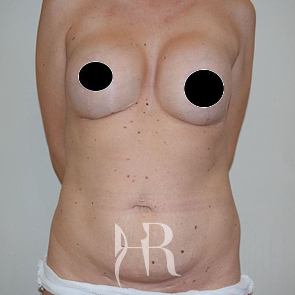 HR Plastic Surgery - Tummy Tuck patient before 19