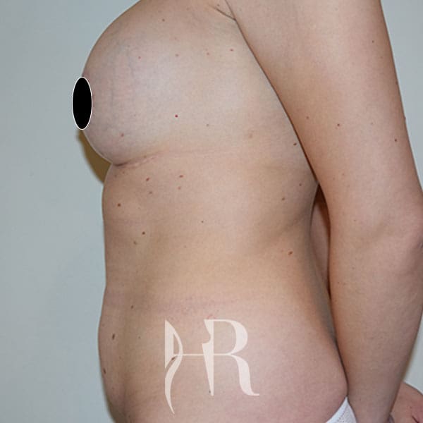 HR Plastic Surgery - Tummy Tuck patient before 21