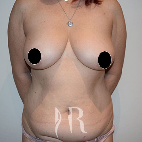 HR Plastic Surgery - Tummy Tuck patient before 22