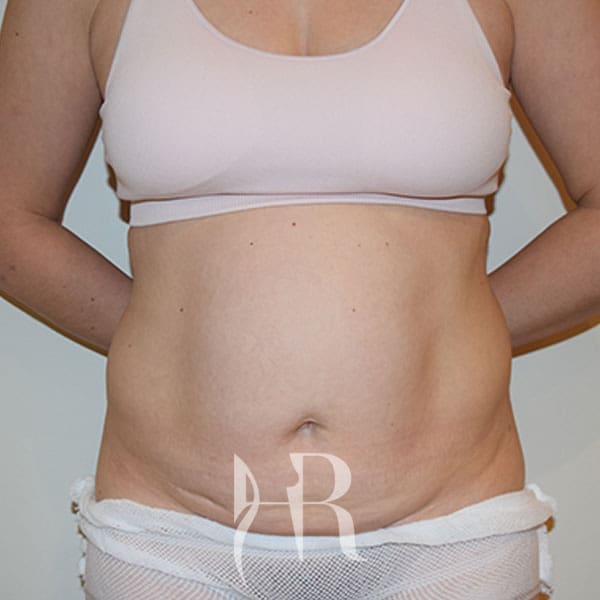 HR Plastic Surgery - Tummy Tuck patient before 23