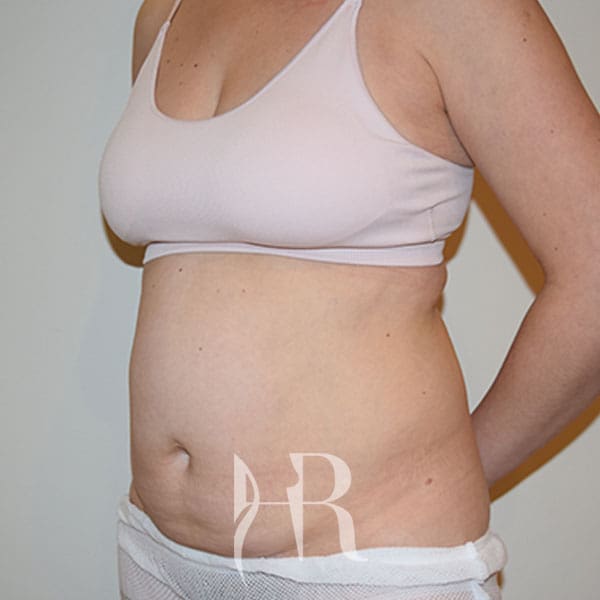HR Plastic Surgery - Tummy Tuck patient before 24