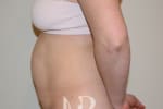 HR Plastic Surgery - Tummy Tuck patient before 25
