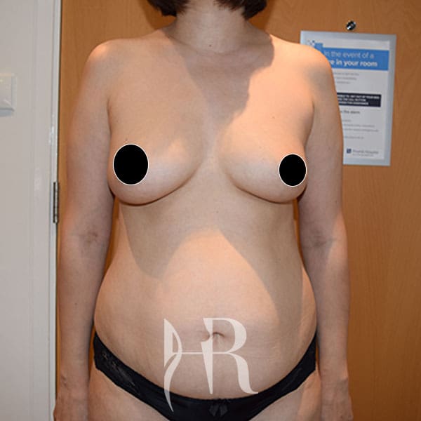 HR Plastic Surgery - Tummy Tuck patient before 26