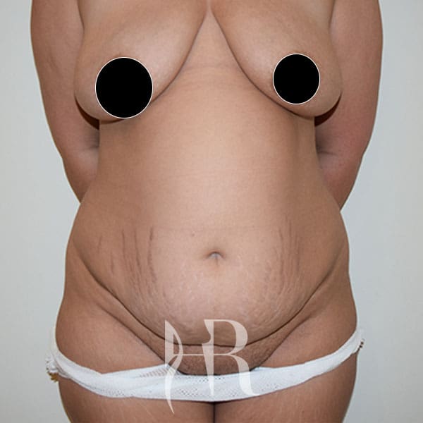 HR Plastic Surgery - Tummy Tuck patient before 6