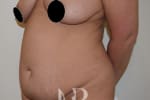 HR Plastic Surgery - Tummy Tuck patient before 7