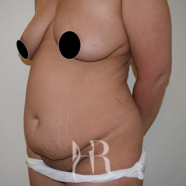 HR Plastic Surgery - Tummy Tuck patient before 7