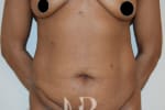 HR Plastic Surgery - Tummy Tuck patient before 9