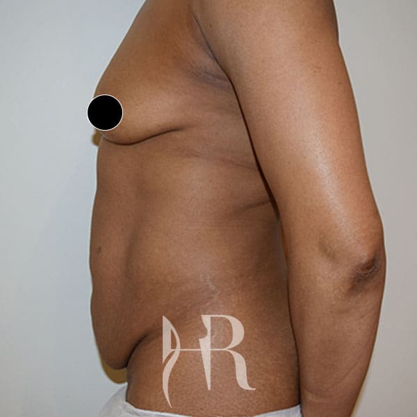 HR Plastic Surgery - Tummy Tuck patient before 10