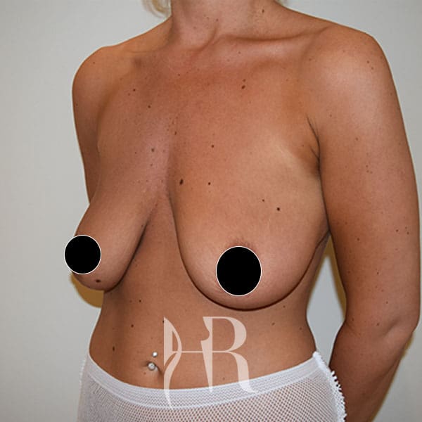 HR Plastic Surgery - Breast Enlargement With Uplift patient before 2