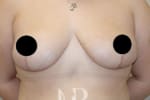 HR Plastic Surgery - Breast Asymmetry patient after 1