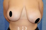 HR Plastic Surgery - Breast Asymmetry patient before 1