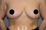 HR Plastic Surgery - Breast Reduction patient after 7