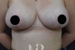 HR Plastic Surgery - Breast Reduction patient after 11