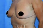 HR Plastic Surgery - Breast Reduction patient after 12